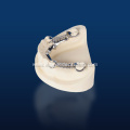 Custom Metal Partial Denture
